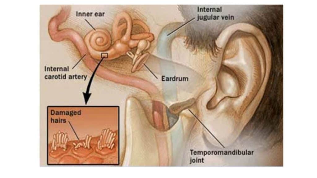 tinnitus-issue