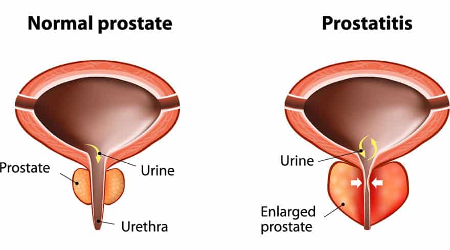 Alt text= difference of normal and prostatitis