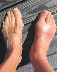 the end of gout reviews shelly manning s ebook exposed by experts