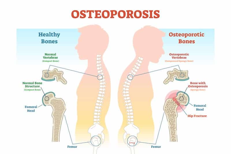 osteoporosis-he-Bone-Density-Solution