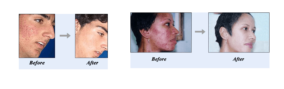 acne no more summary