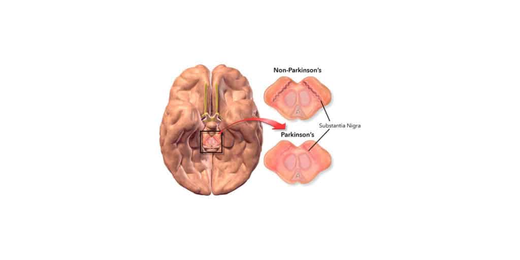 Parkinson's Health