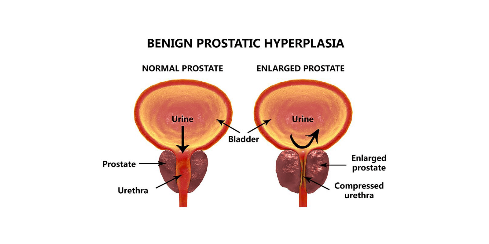  Benign Prostatic Hyperplasia(BPH)