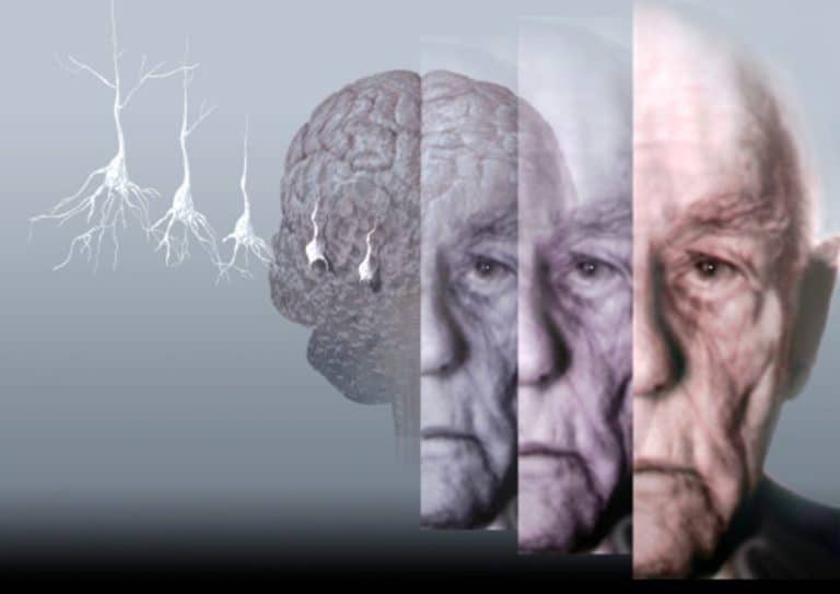 Alzheimer’s Appear To Affect The Brain Likewise