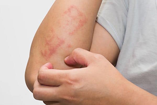 A Drug Named Upadacitinib Can Ease Eczema