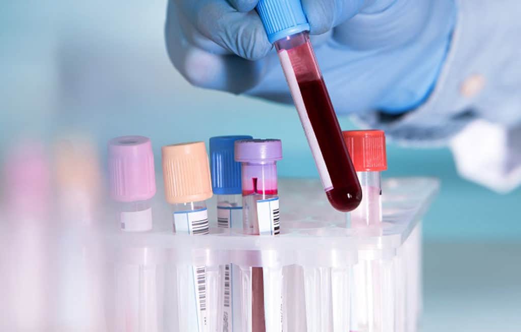 Can A Range Of Hidden Cancer Be Detected With A DNA Blood Sample?