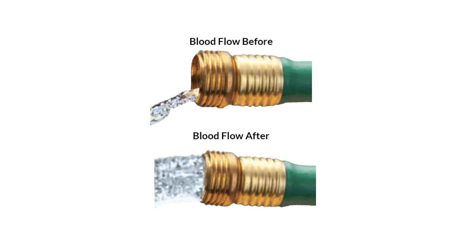 Blood Flow- Before & After