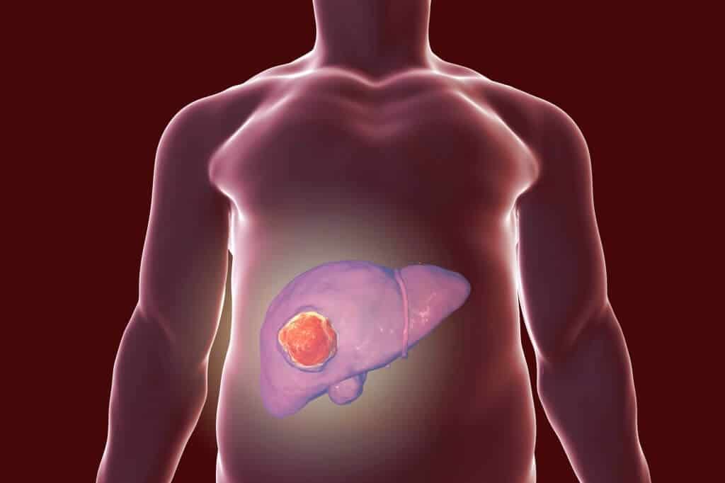 Rural America Experiences A Rise In Liver Cancer Cases