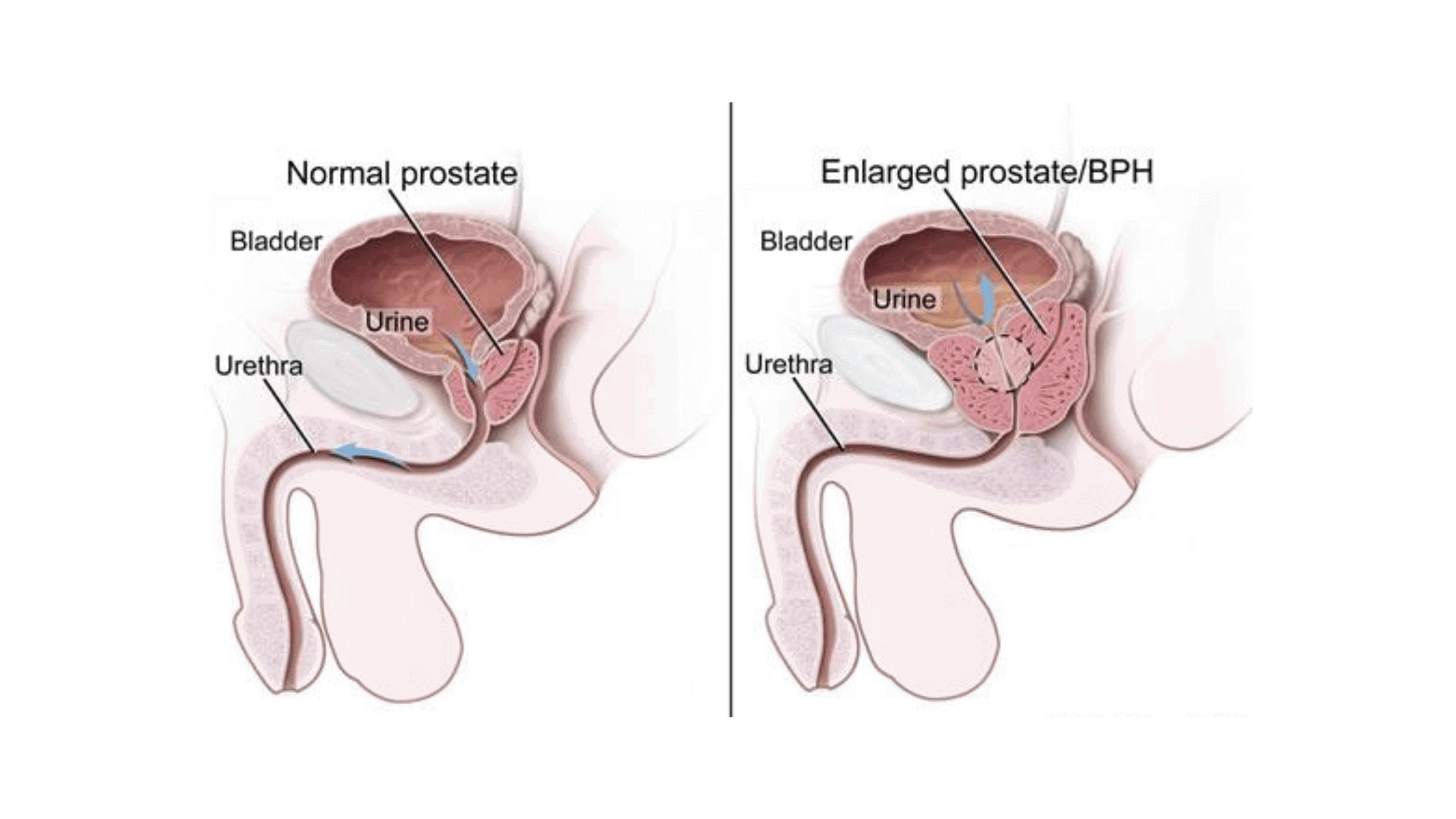 Prostate Plus Normal and enlarged