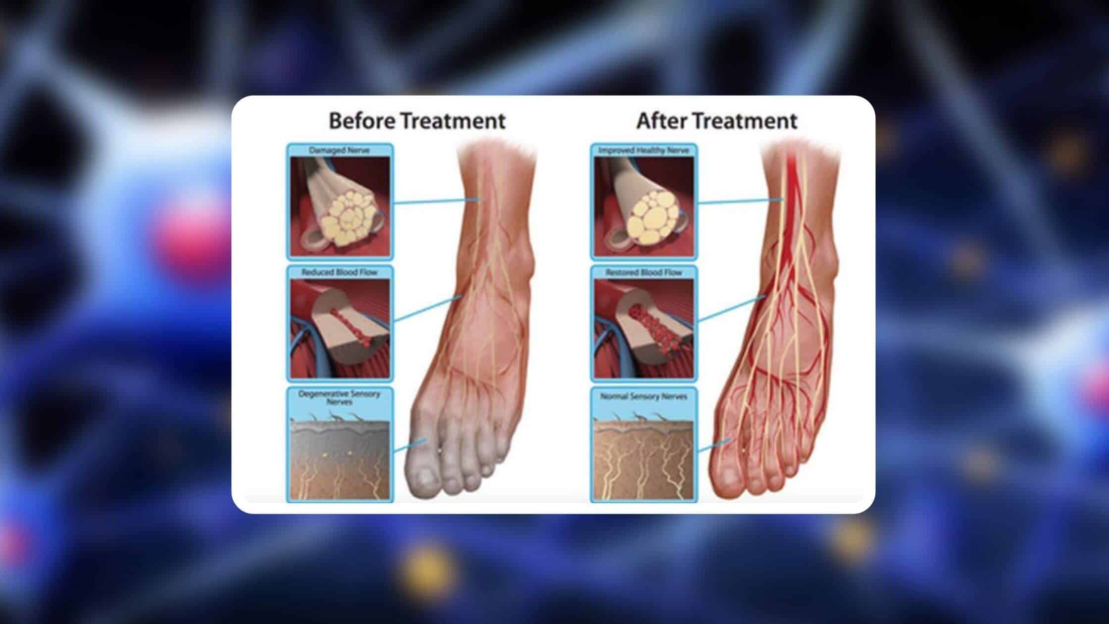 Neuropathy Revolution Benefits