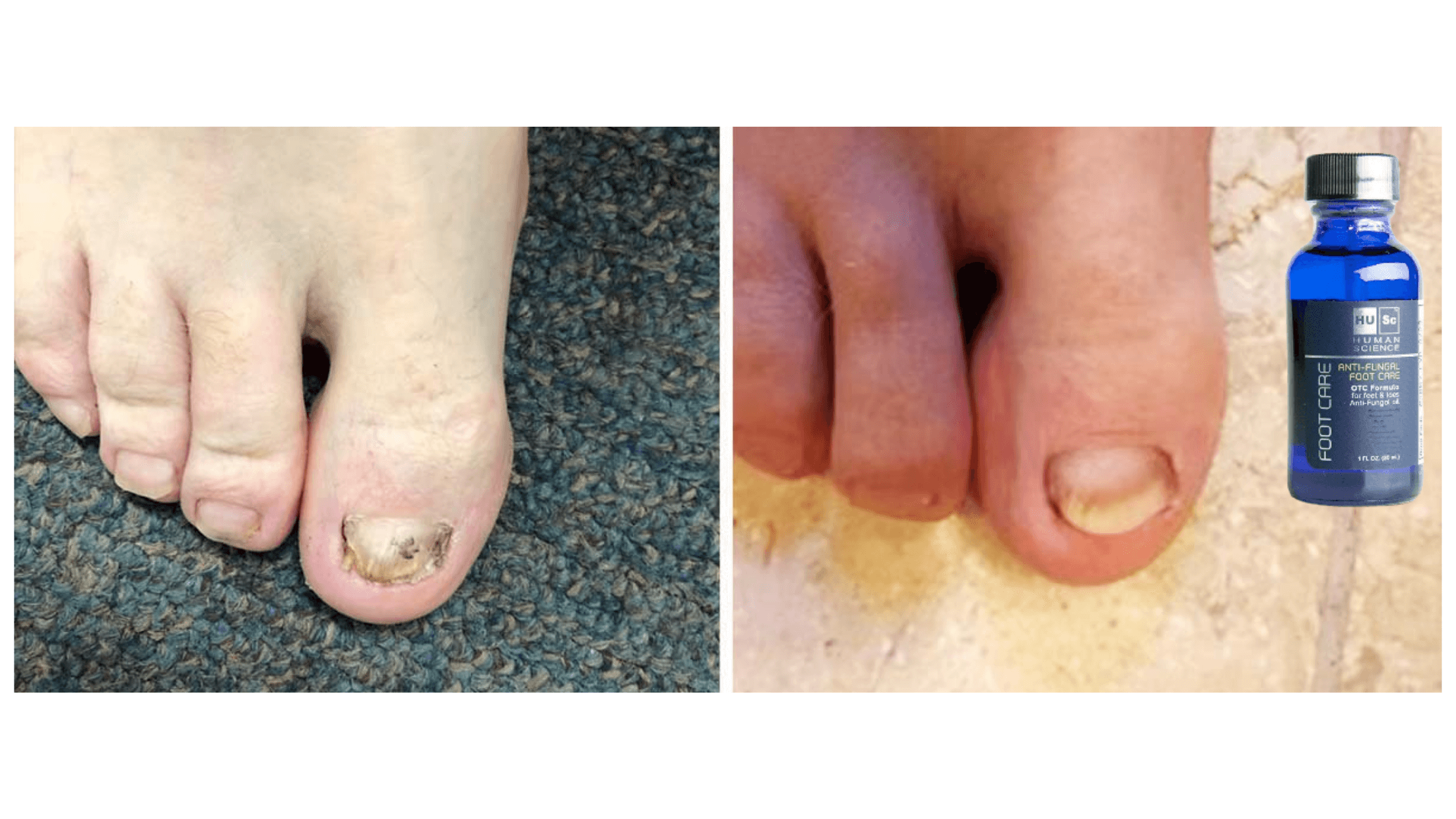 Human Science Antifungal Foot Care Oil Results