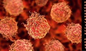 Epstein-Barr Virus May Cause Multiple Sclerosis