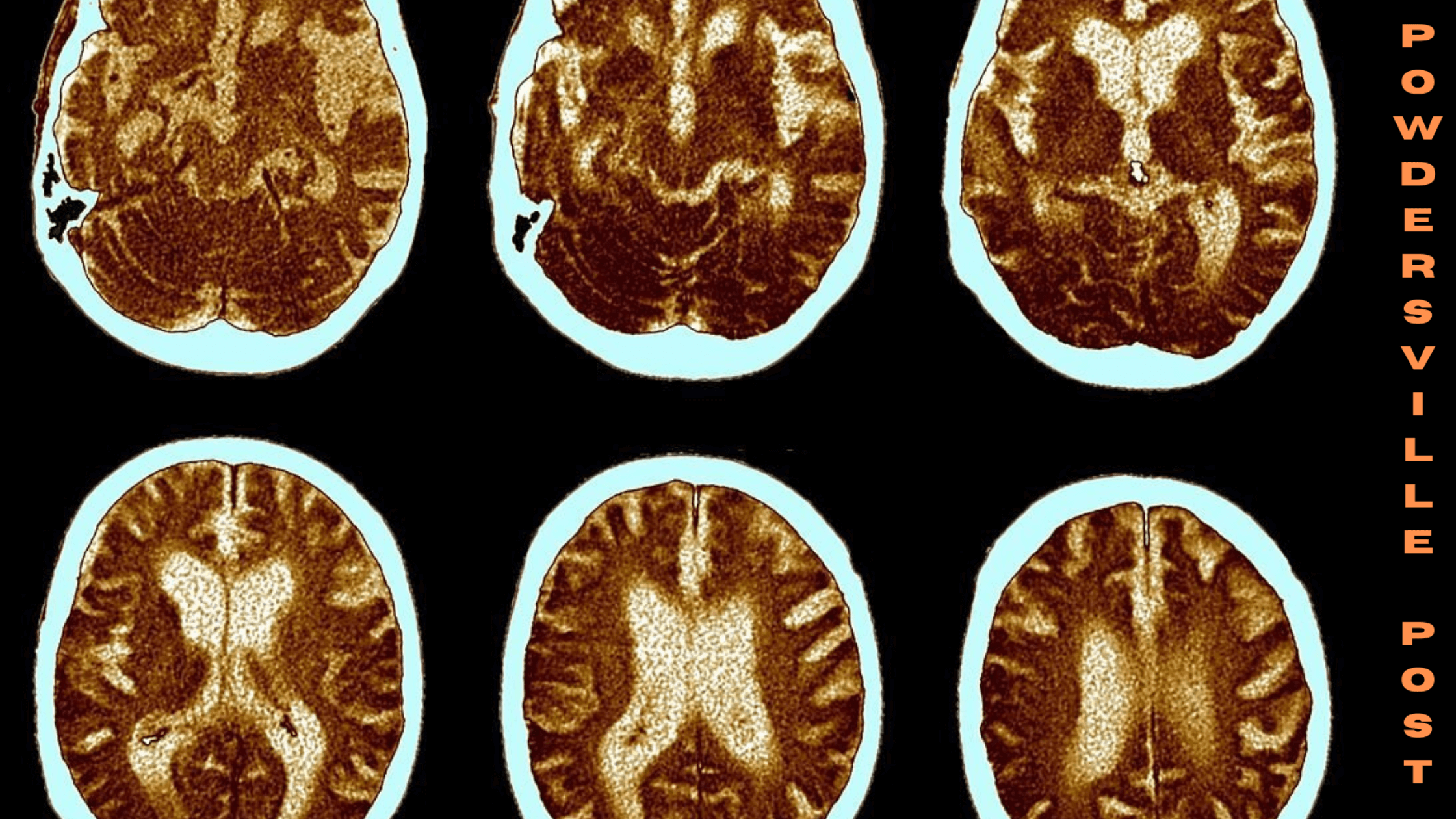 Alzheimer’s Biomarkers Linked To Poor Score In Simple Memory Test