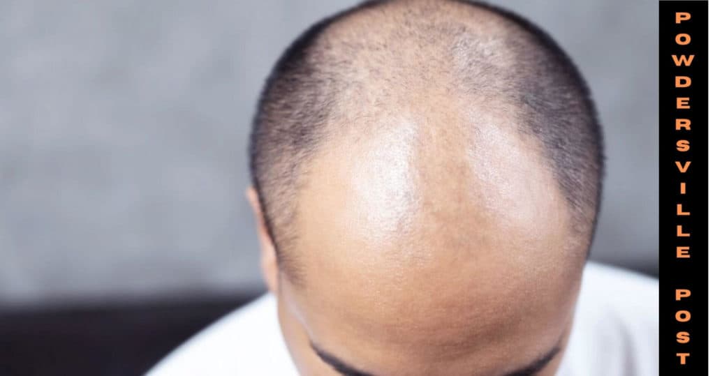 Hair Loss In Males And The Best Treatment Latest News! 