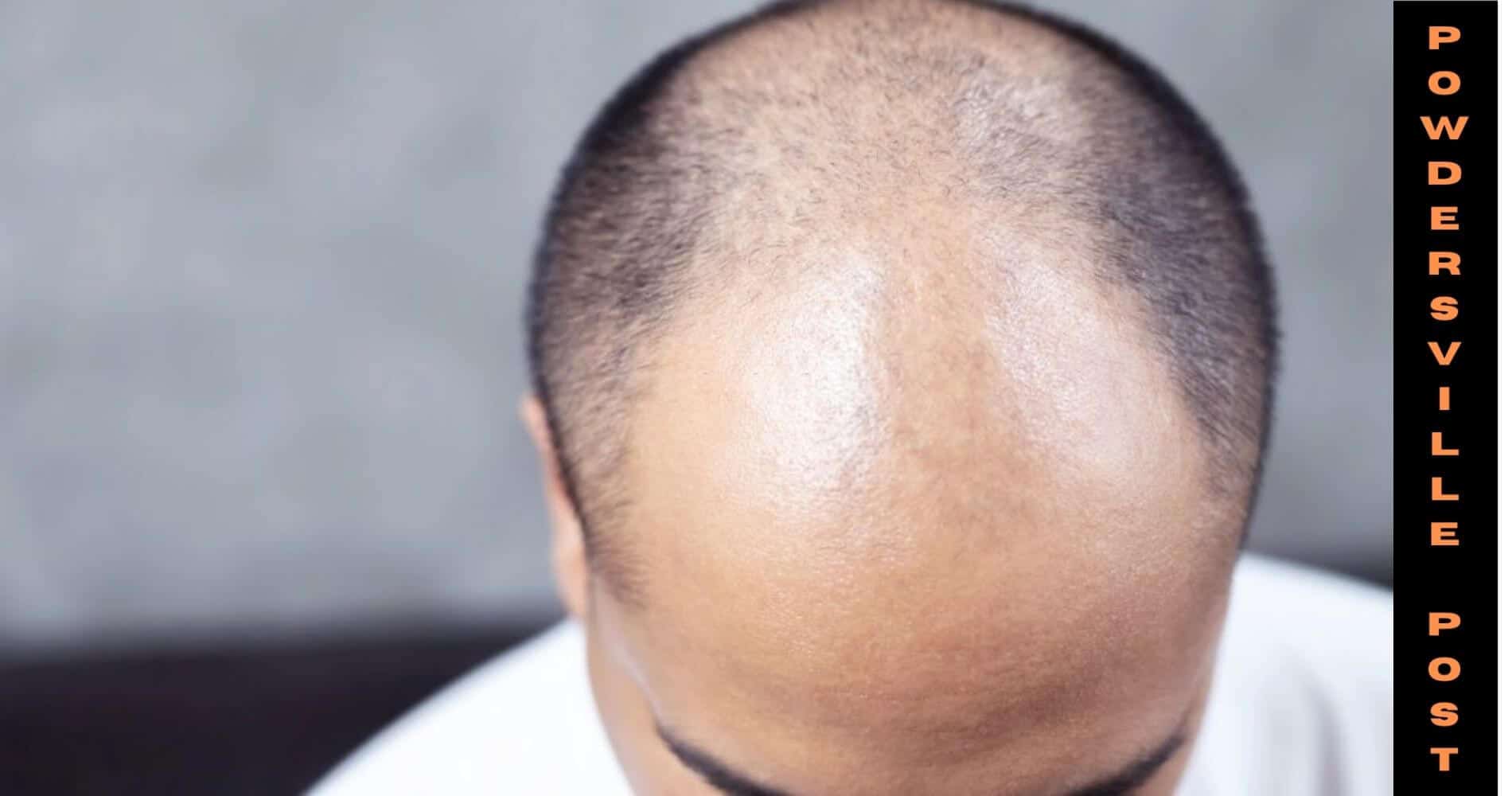 Hair Loss In Males And The Best Treatment Latest News!