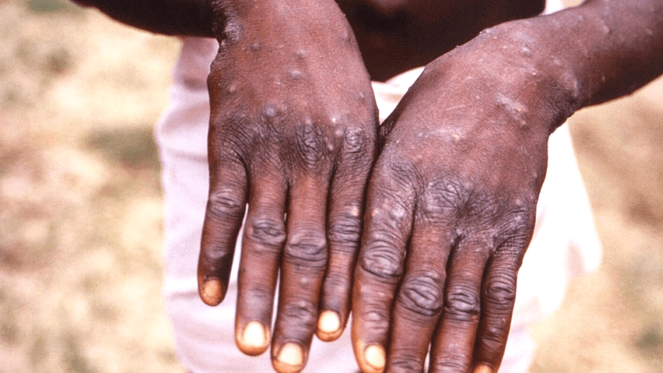 Action Plan To Monkeypox Outbreak: Stay Safe Over NYC’s Heat Wave!