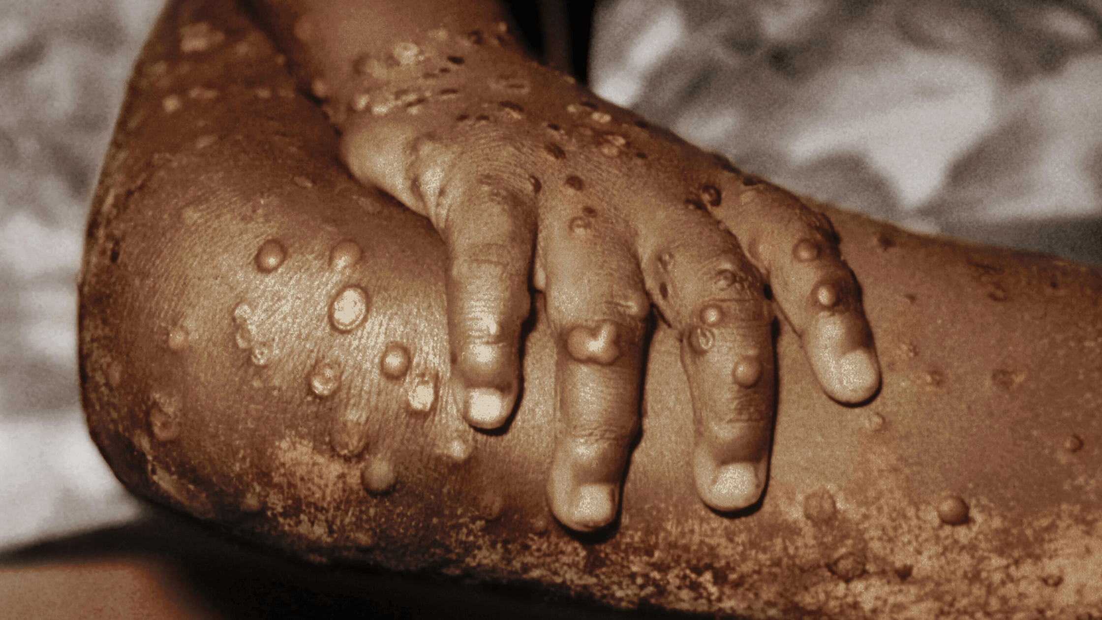 Causes And Symptoms Of MonkeyPox