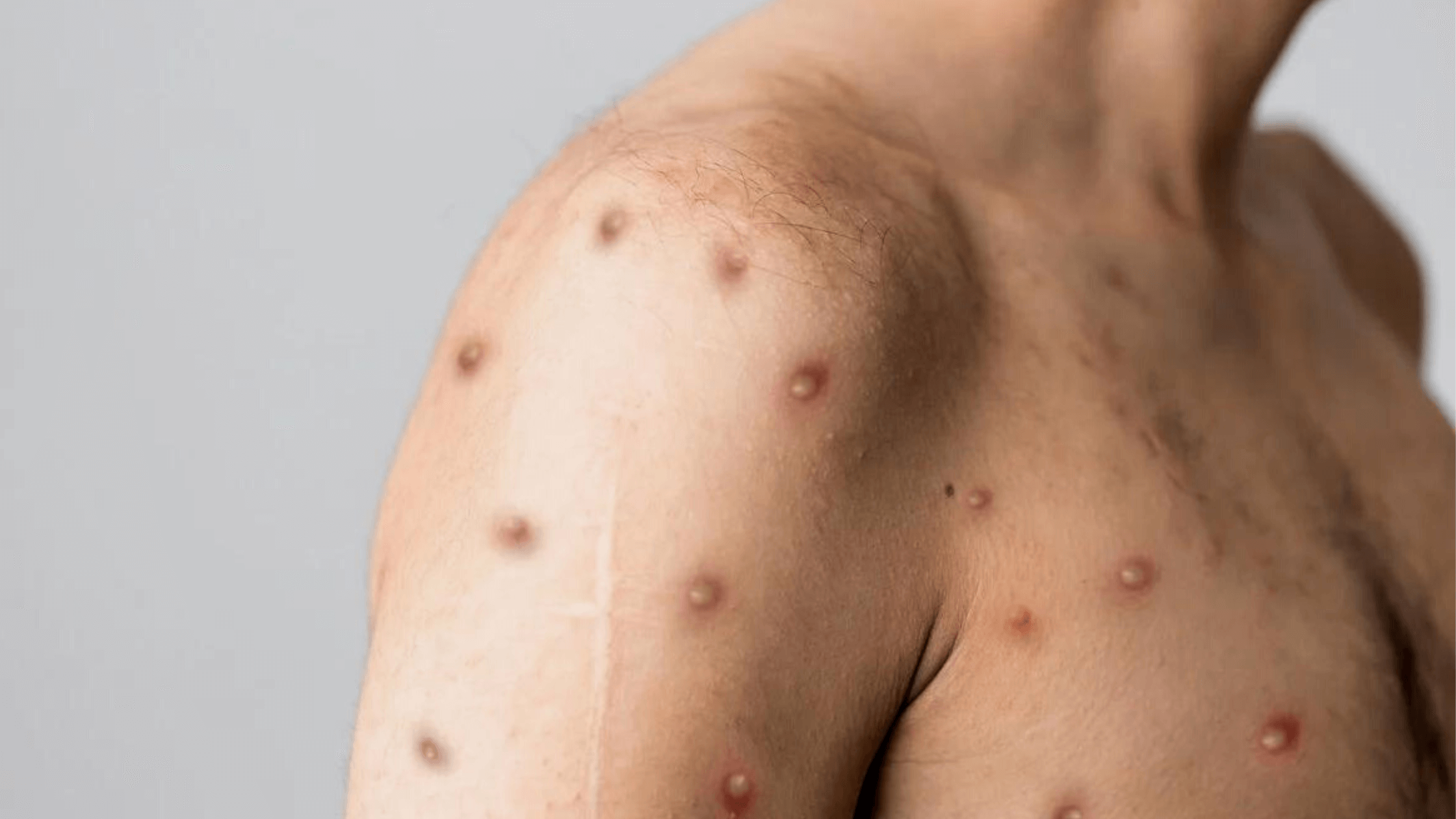Monkeypox Chance To Become New STD Virus In US