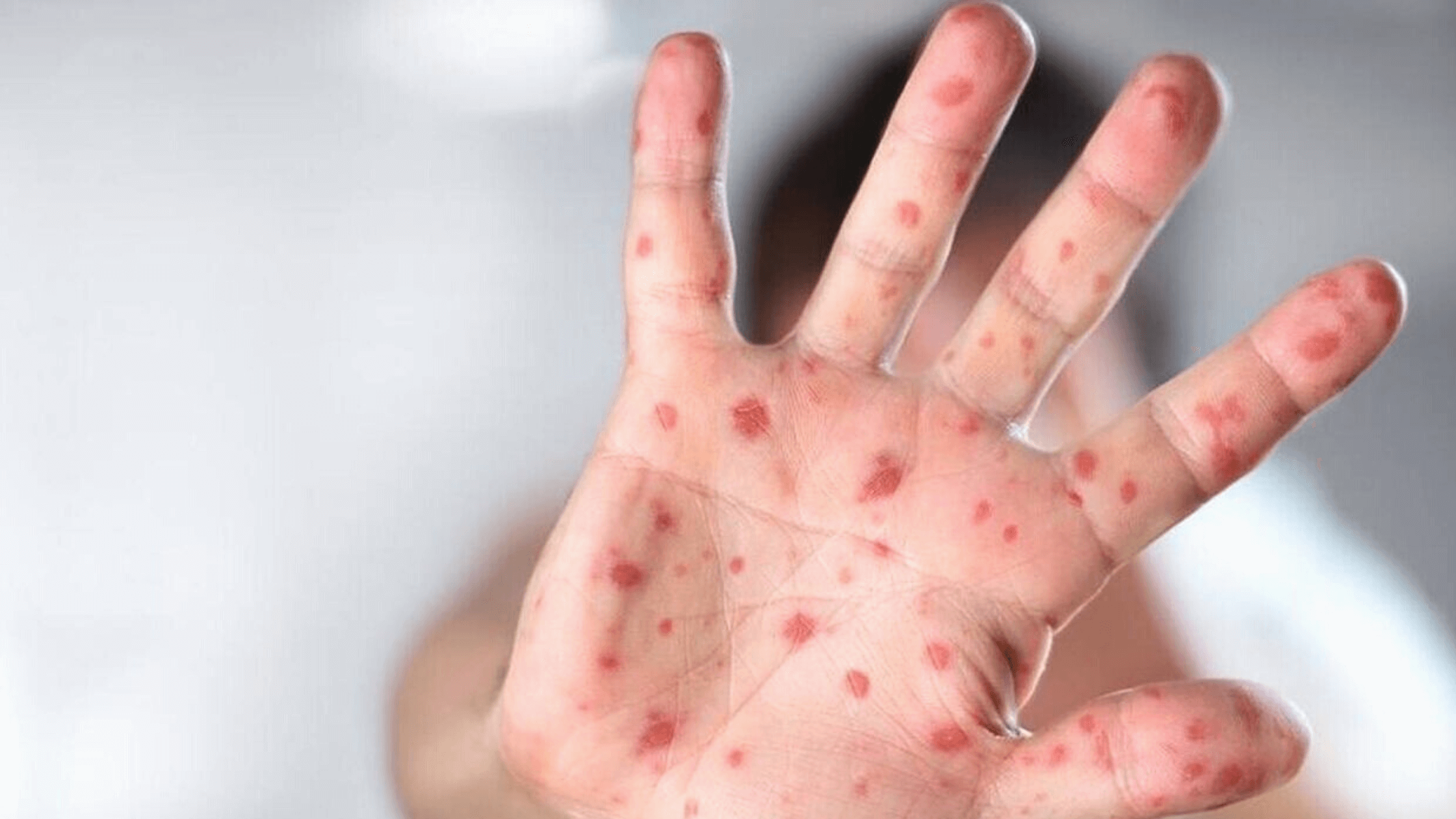 Monkeypox Chance To Become New STD Virus In US