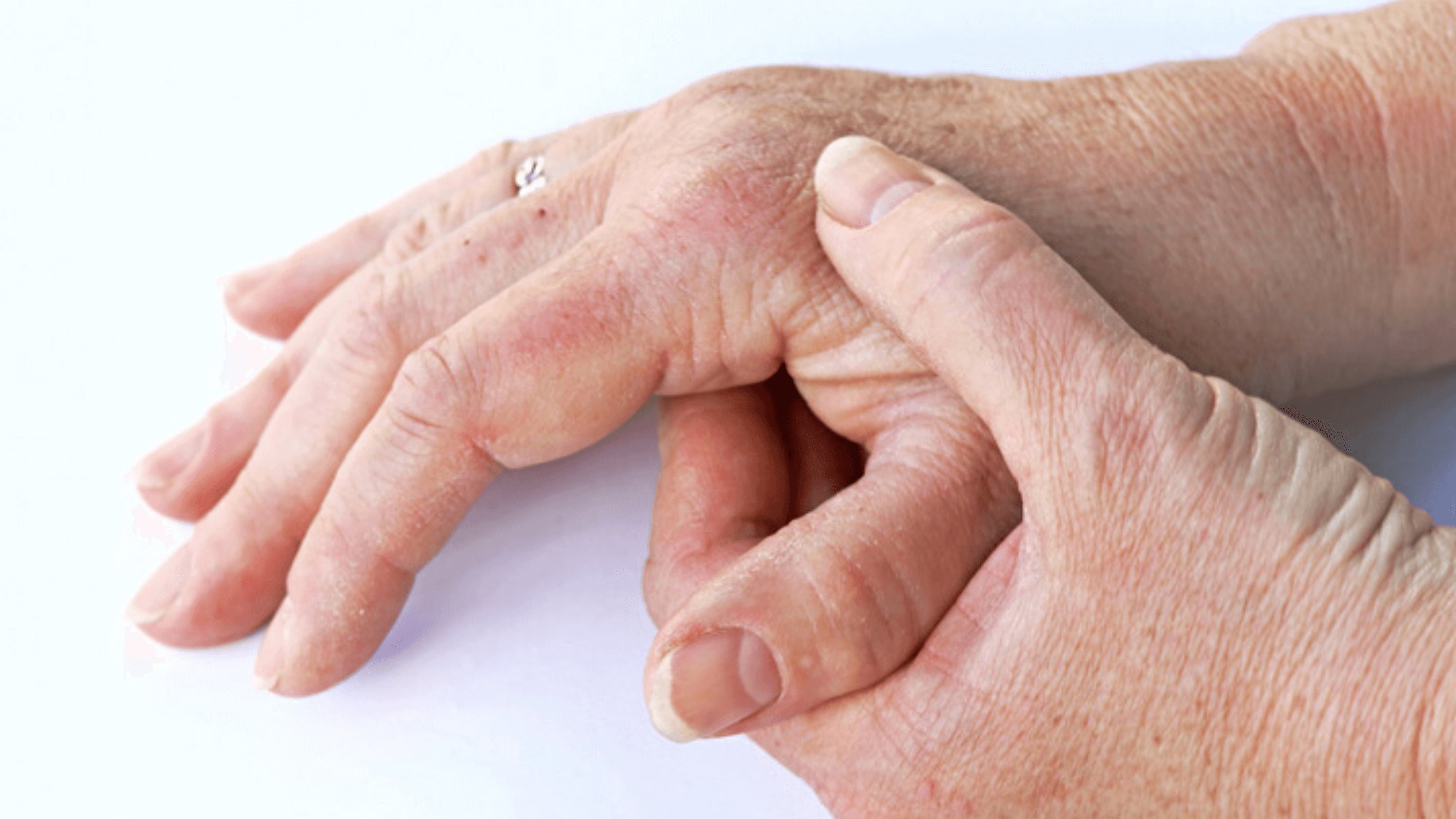 Psoriatic Arthritis Treatments Are Not Getting Better Results