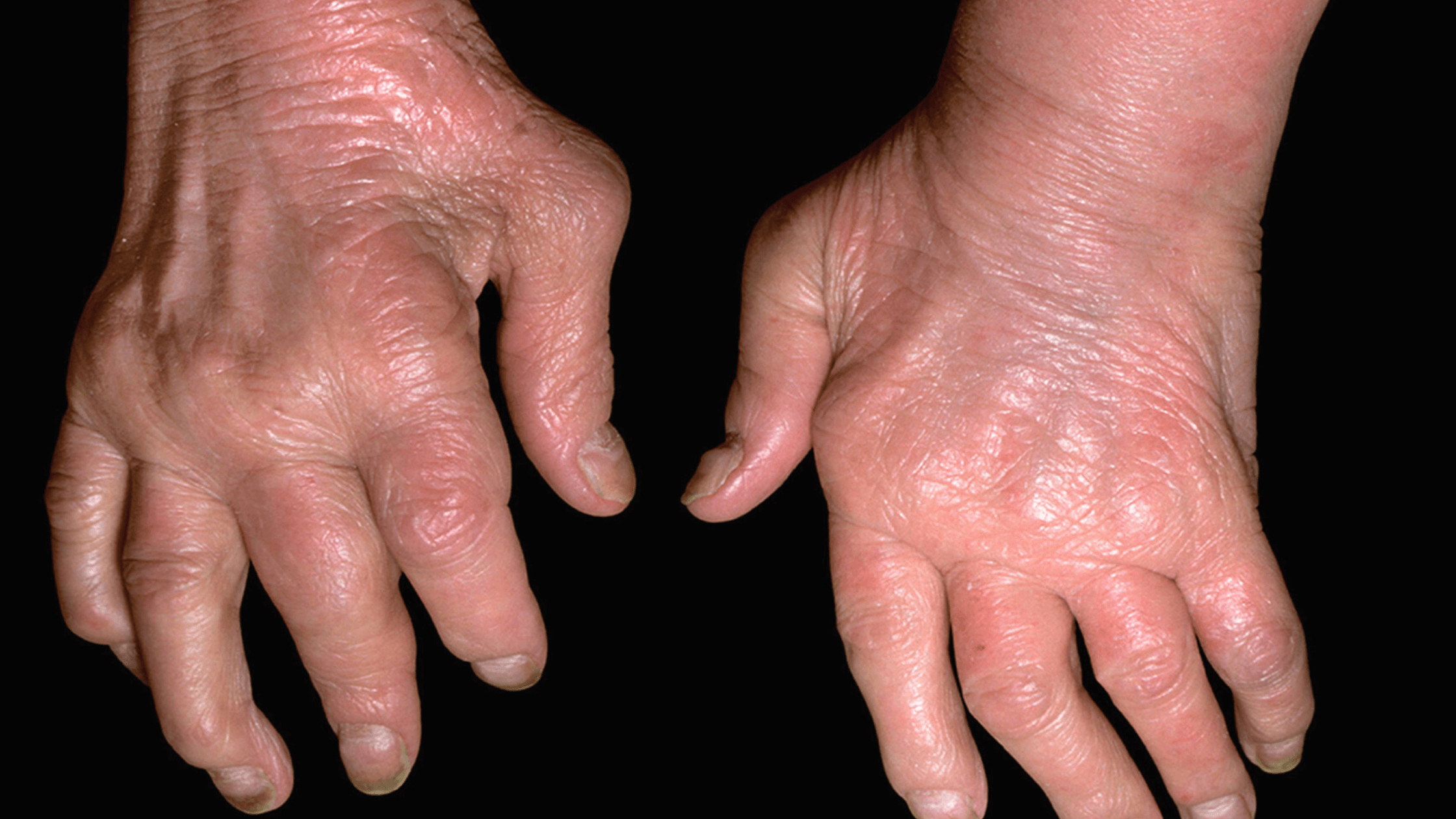 Psoriatic Arthritis Treatments Are Not Getting Better Results