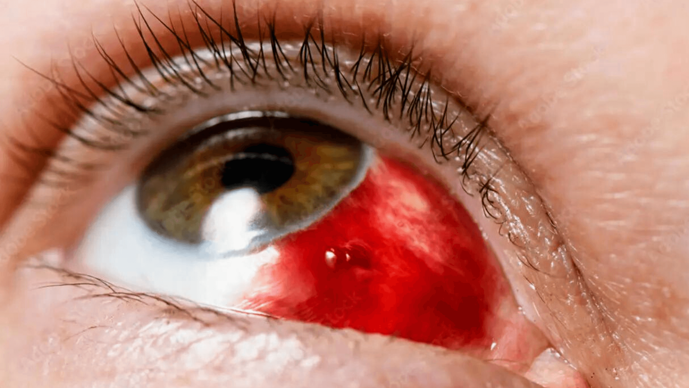 The Deadly Balkan Eye-Bleeding Virus Chance To Dying Of Spanish People