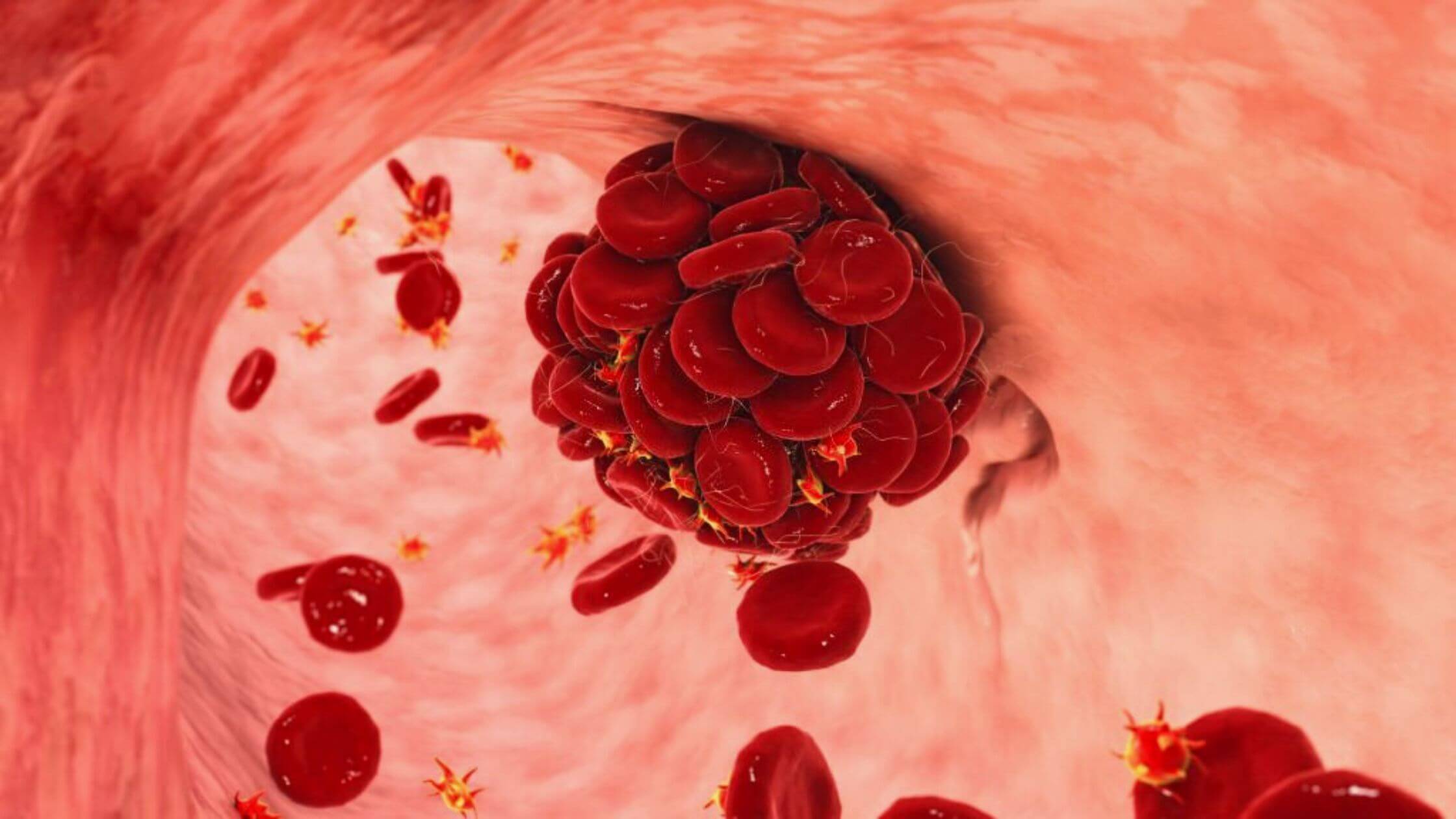 A Blood Clots Early Symptoms Should Never Be Ignored