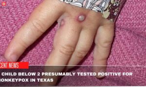 A Child Below 2 Presumably Tested Positive For Monkeypox In Texas