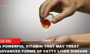 A Powerful Vitamin That May Treat Advanced Forms Of Fatty Liver Disease