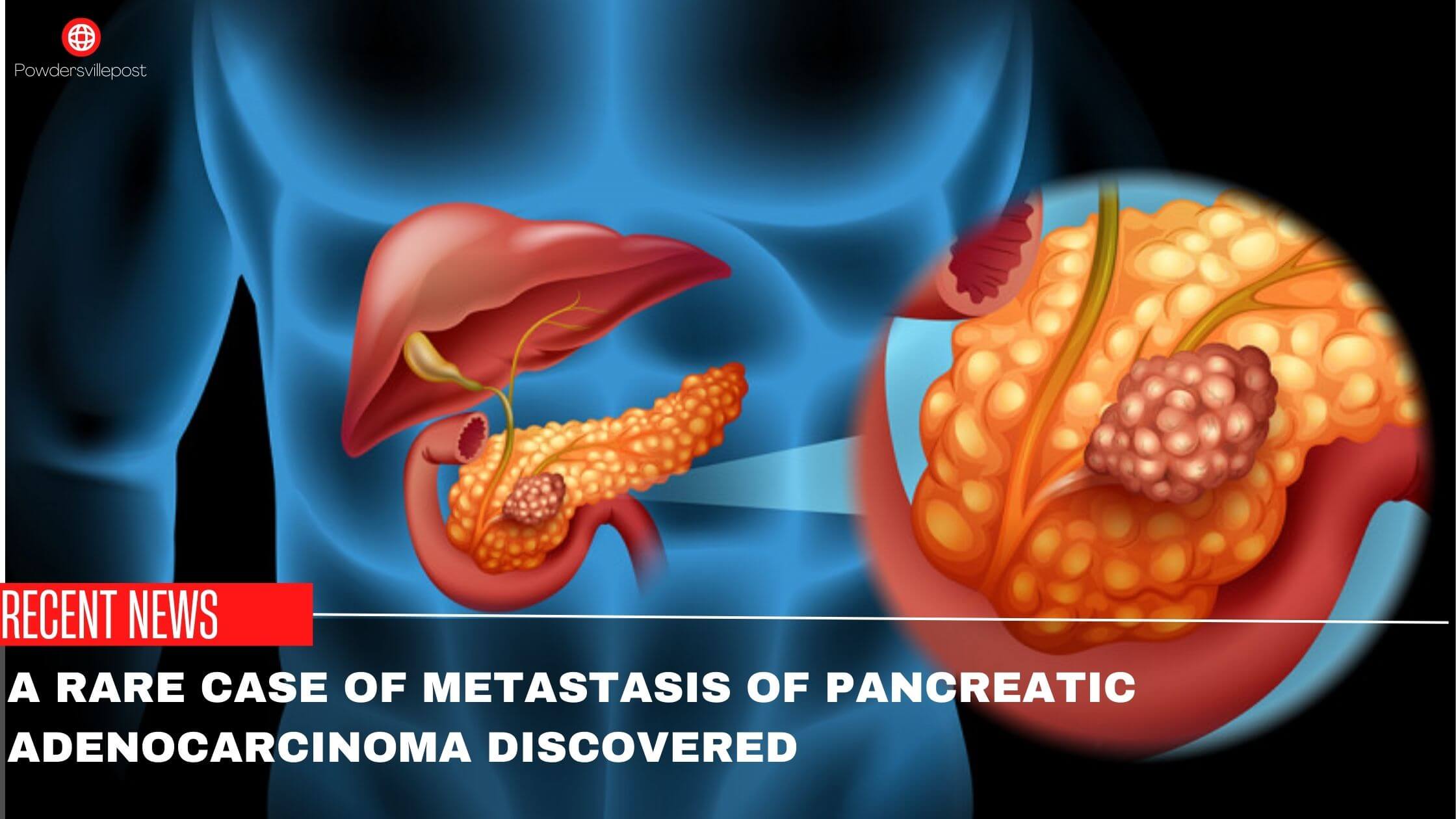 A Rare Case Of Metastasis Of Pancreatic Adenocarcinoma Discovered