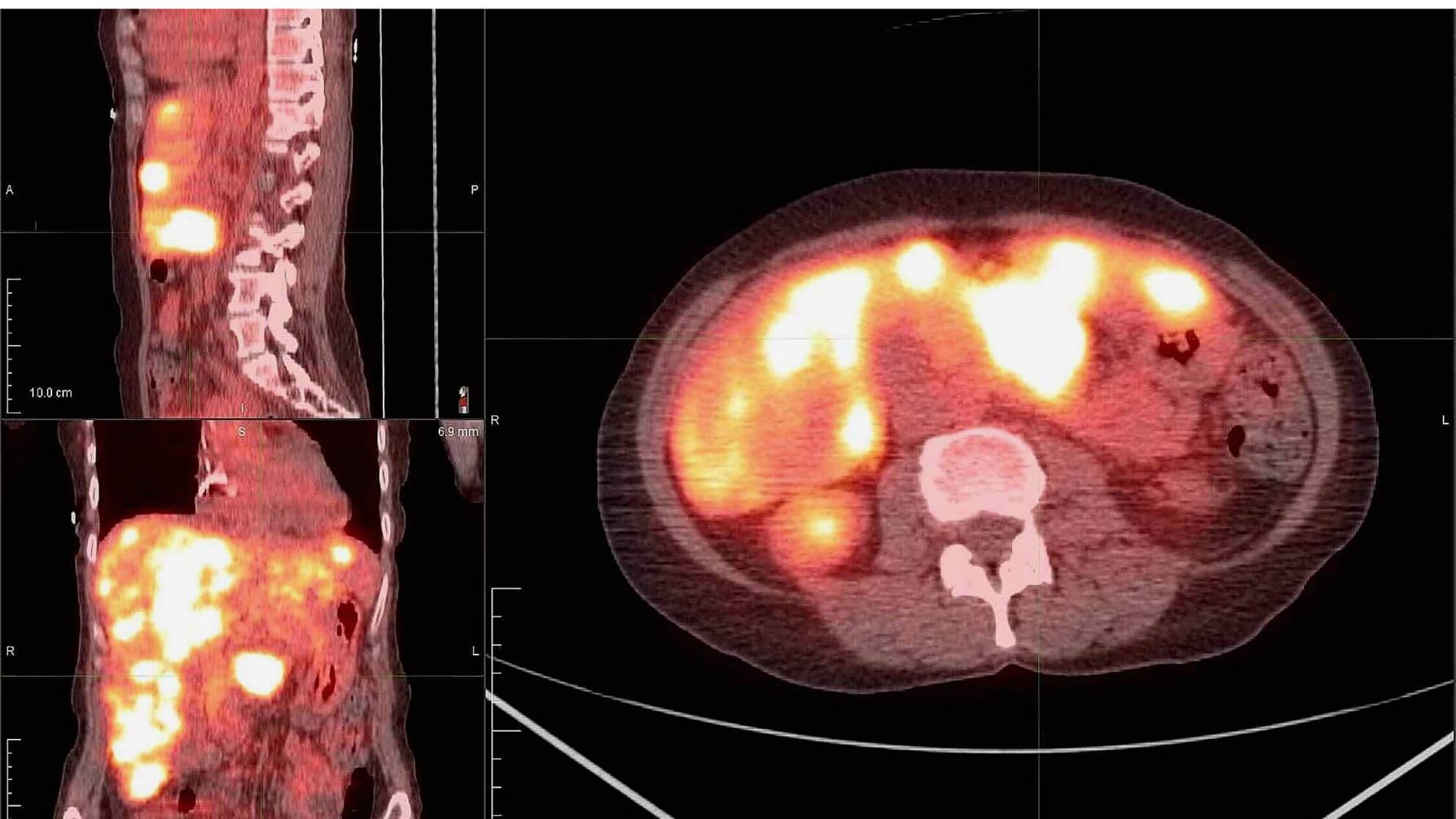 A Rare Case Of Metastasis Of Pancreatic Adenocarcinoma Discovered