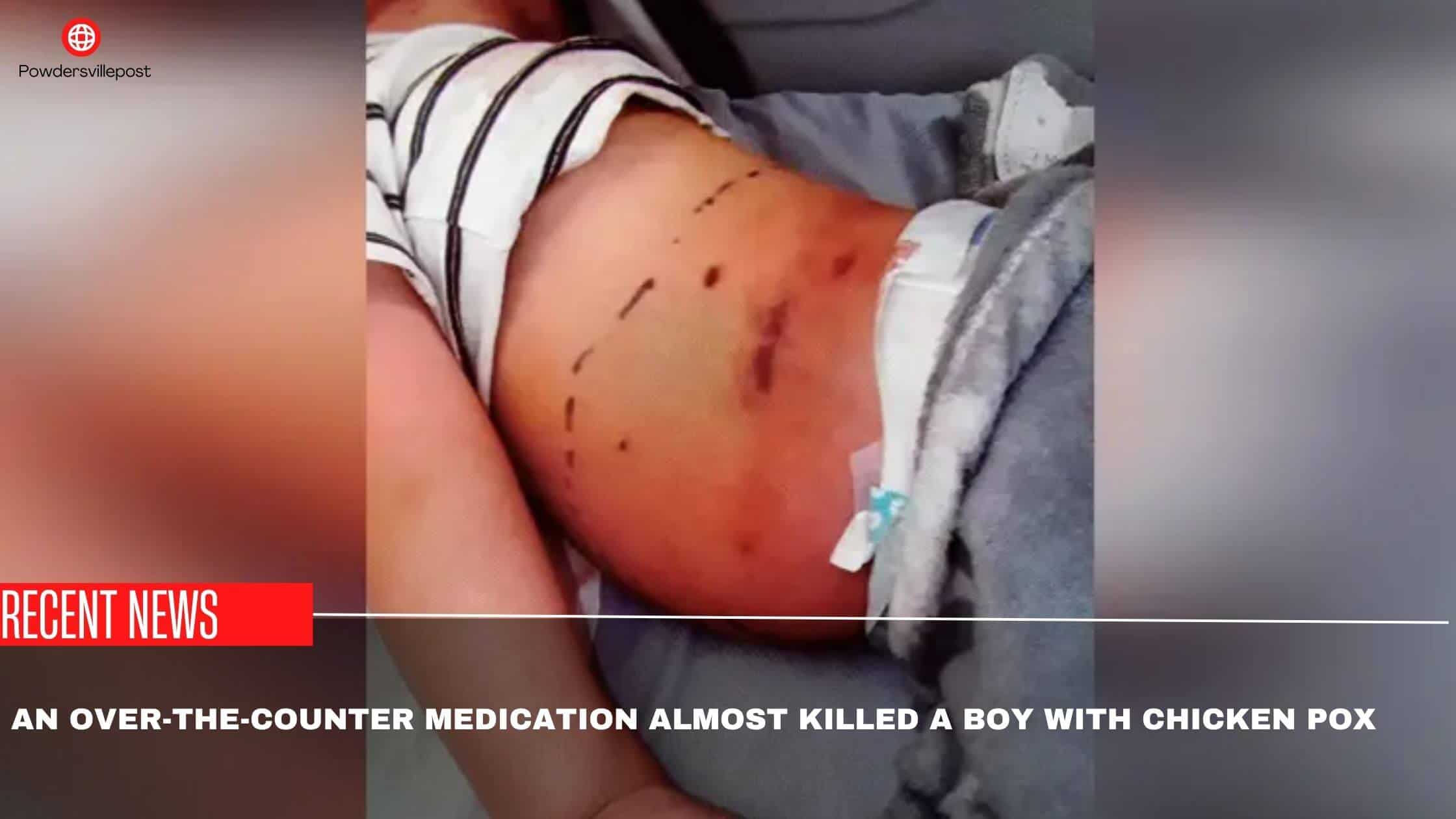 An Over-The-Counter Medication Almost Killed A Boy With Chicken Pox