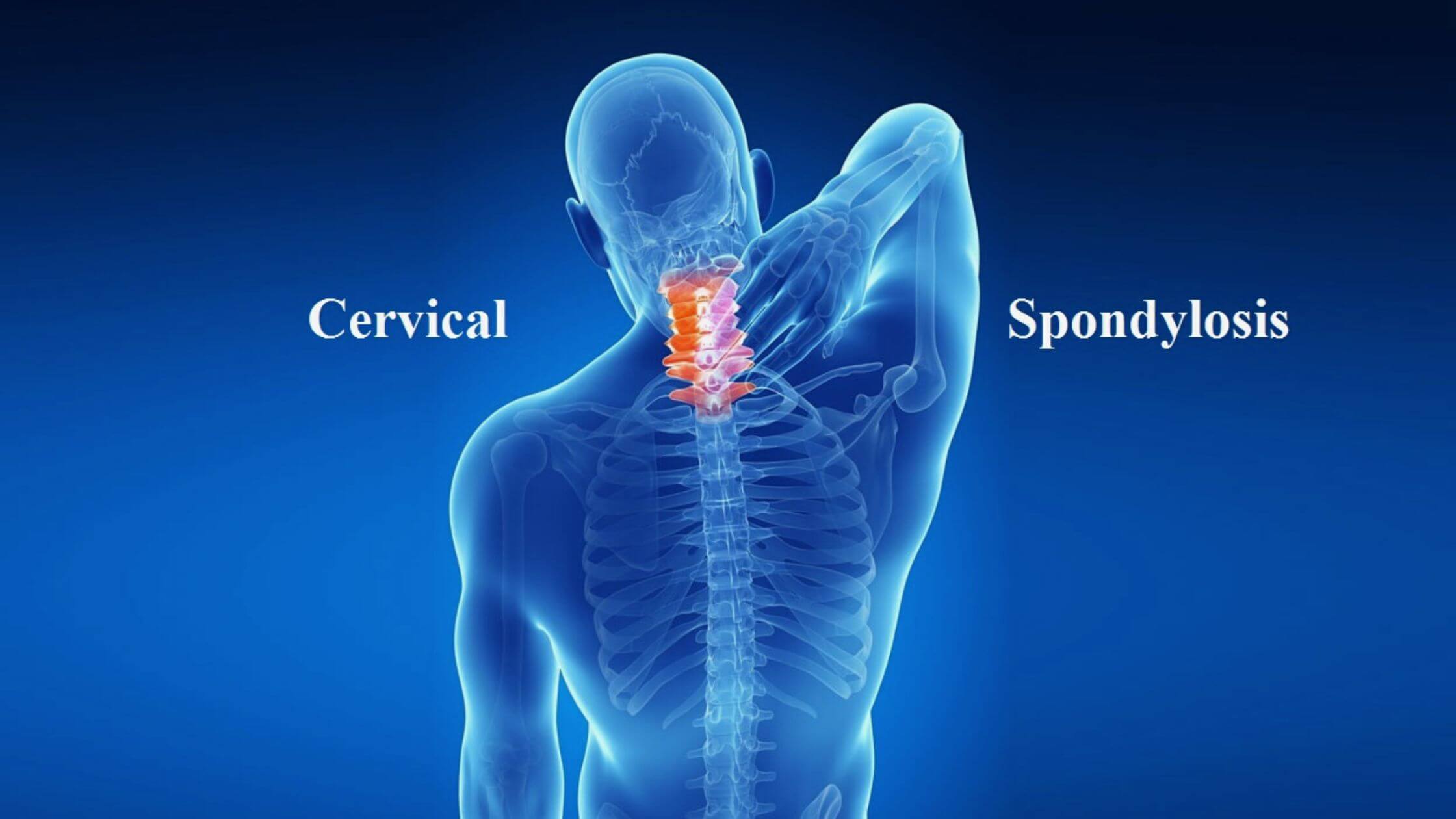 Cervical Spondylosis Things You Need To Know Symptoms