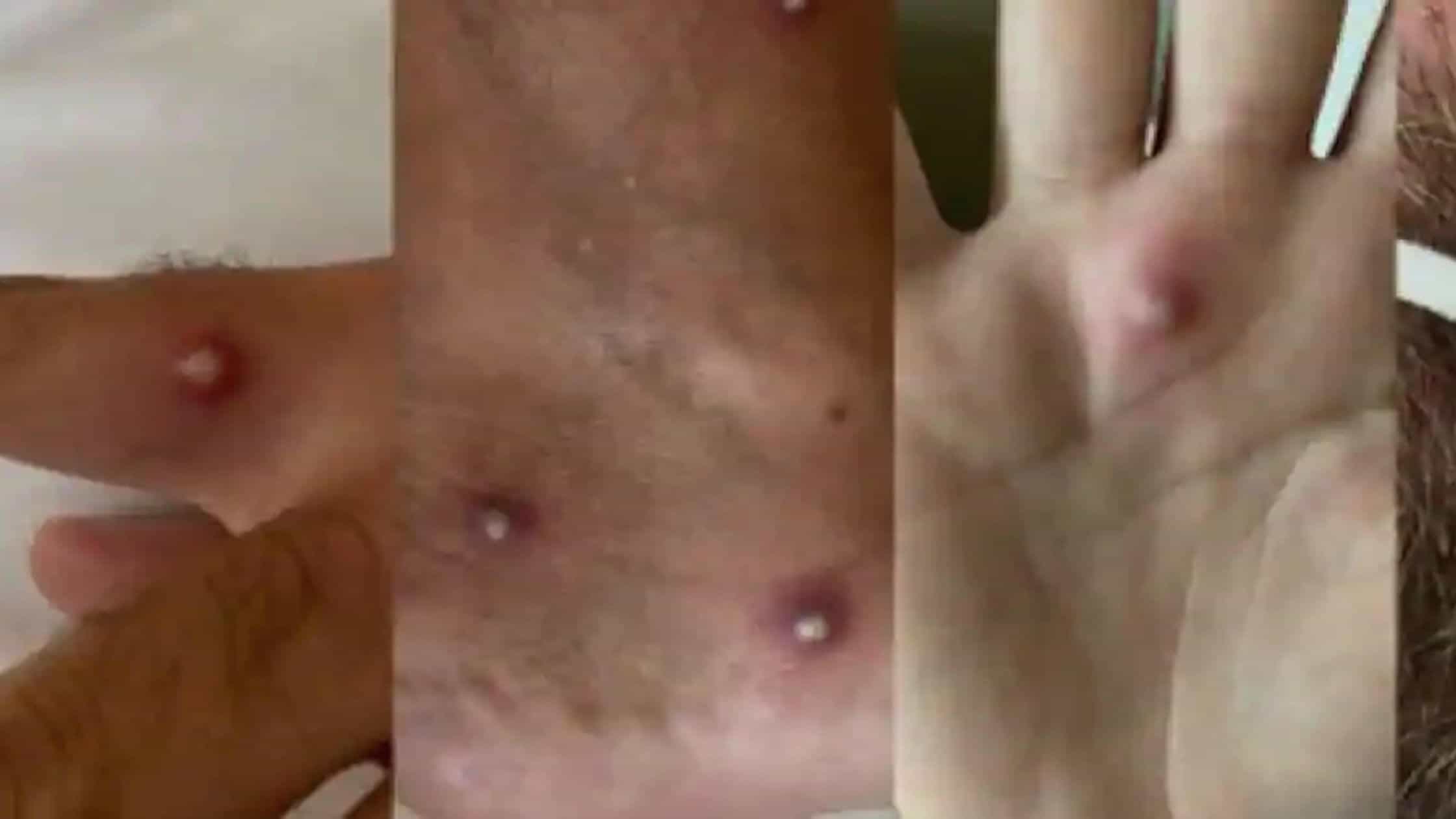 Covid-19, Monkeypox And HIV All Are Detected In The Same Italian Man