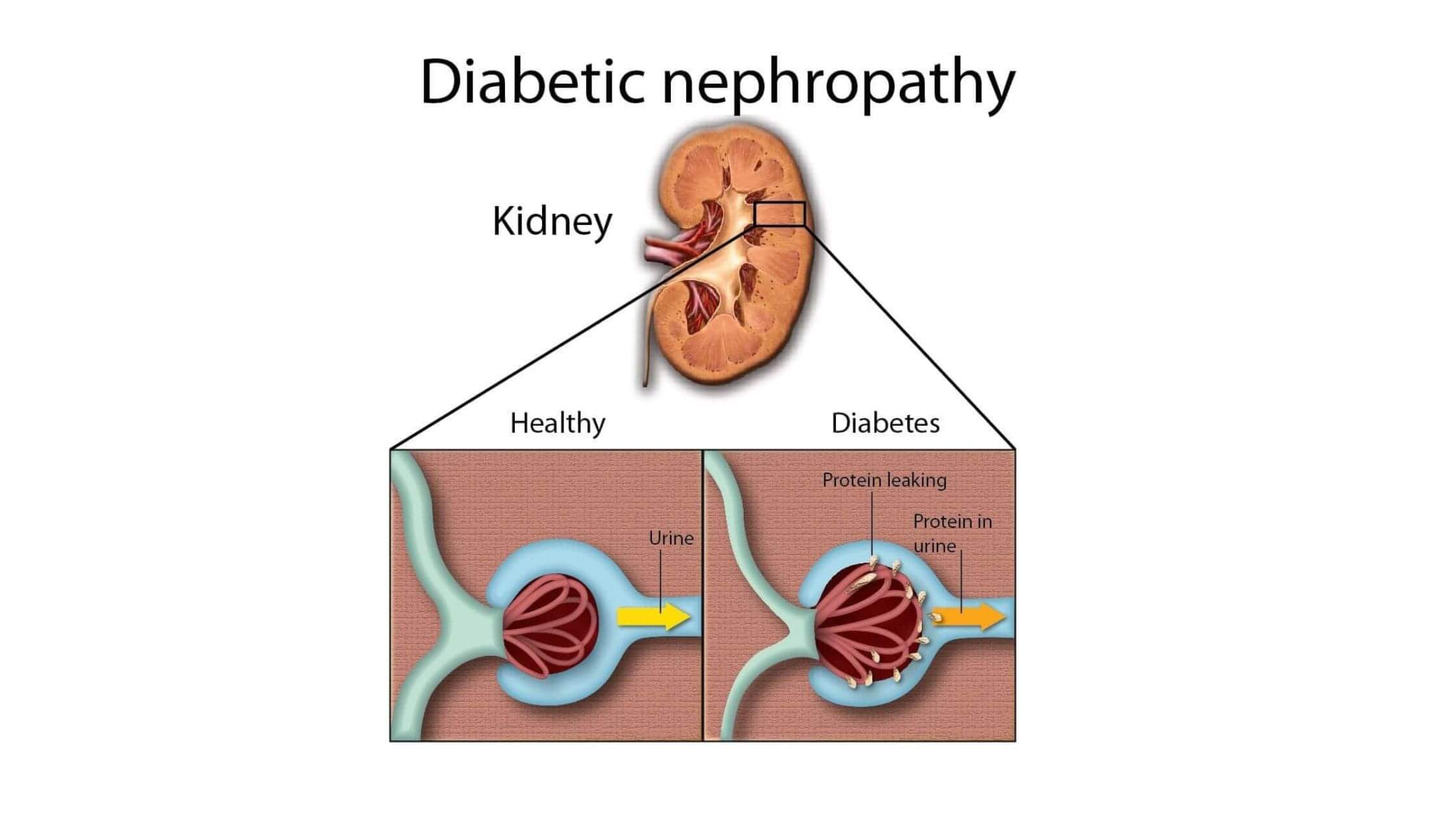  Diabetic Nephropathy Market Size And Revenue