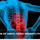 Early Signs Of Ankylosing Spondylitis Recent Study