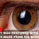Eyesight Was Restored With Cornea Implants Made From Pig Skin!