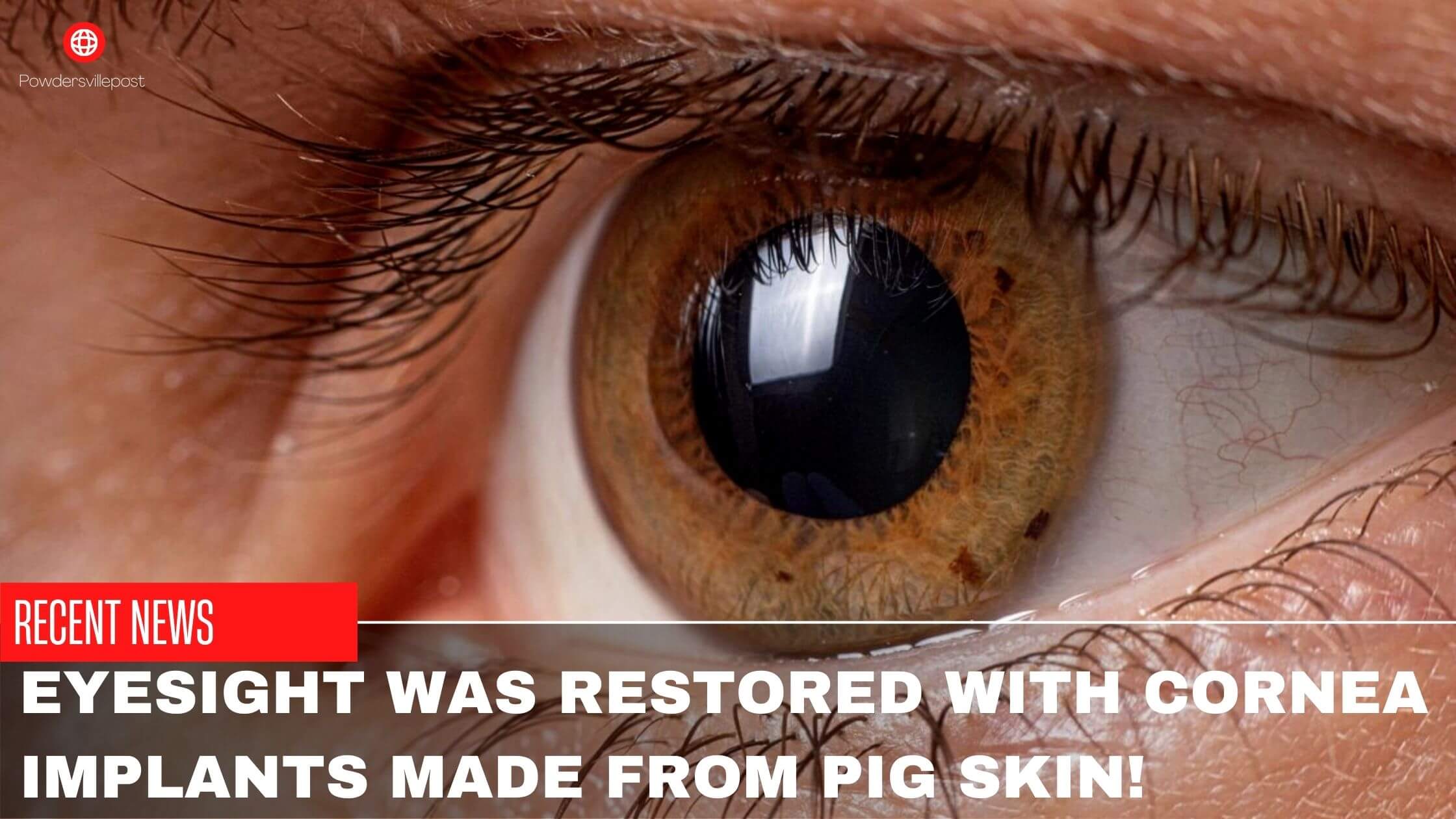 Eyesight Was Restored With Cornea Implants Made From Pig Skin!