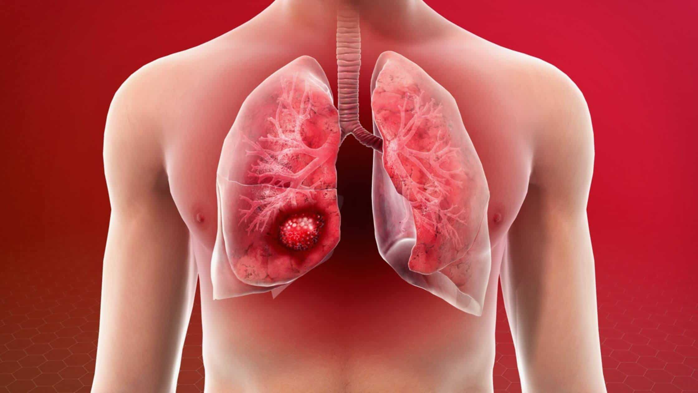 In Southeast Nebraska, Lung Cancer Is The Deadliest Cancer Not Just Among Smokers