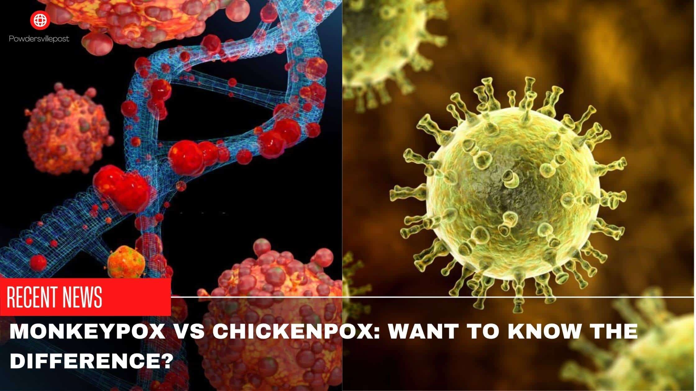 Monkeypox vs Chickenpox Want To Know The Difference