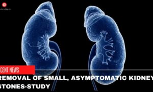 Removal Of Small, Asymptomatic Kidney Stones-Study