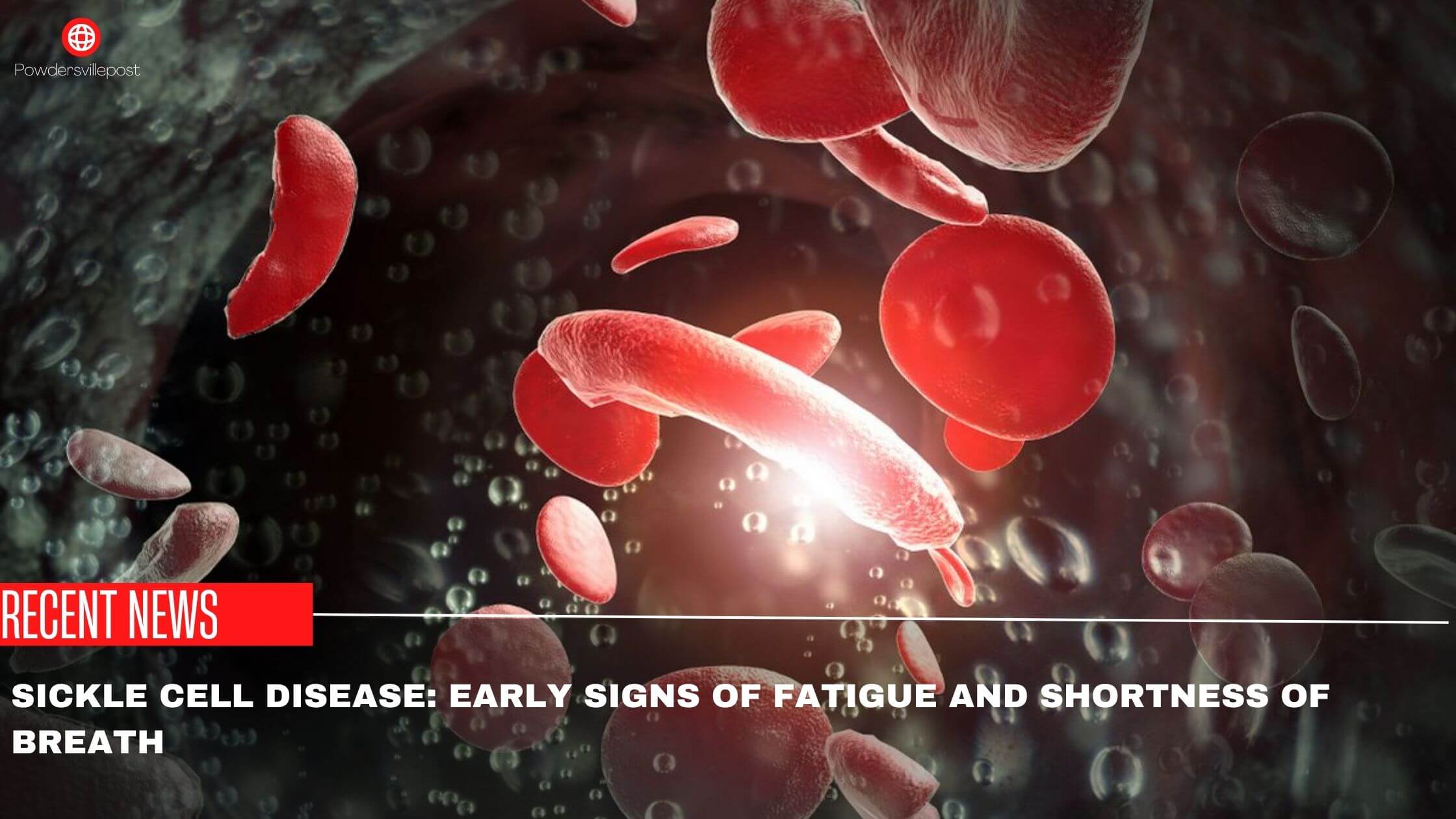 Sickle Cell Disease Early Signs Of Fatigue And Shortness Of Breath