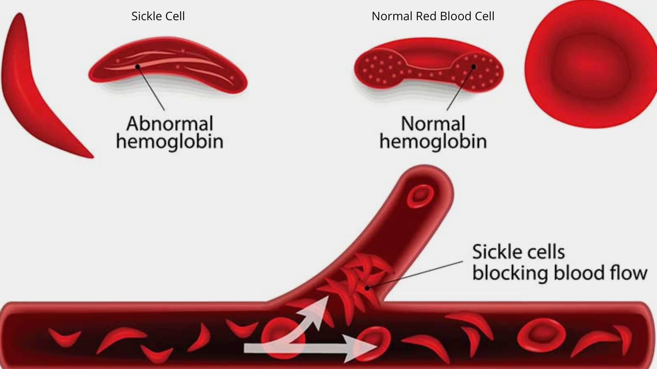 Sickle Cell Disease: Early Signs Of Fatigue And Shortness Of Breath