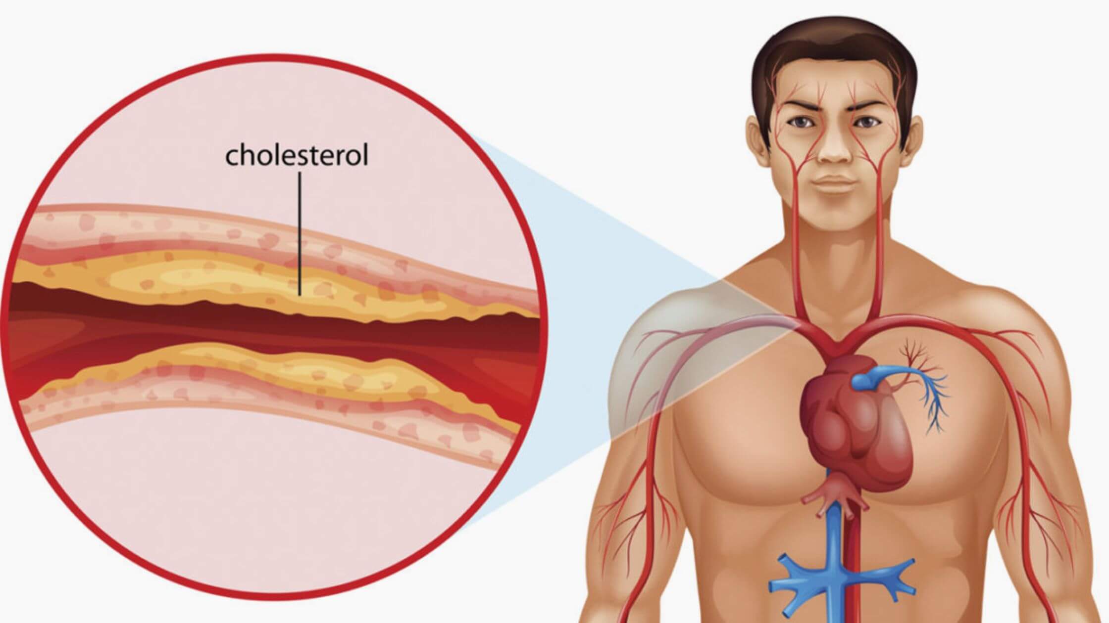 High Cholesterol: The Signs In Your Leg Warning Of Extremely Damaging Levels
