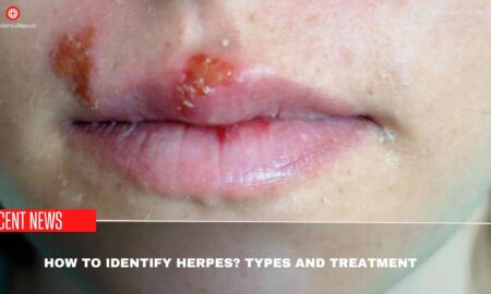 How To Identify Herpes Types And Treatment