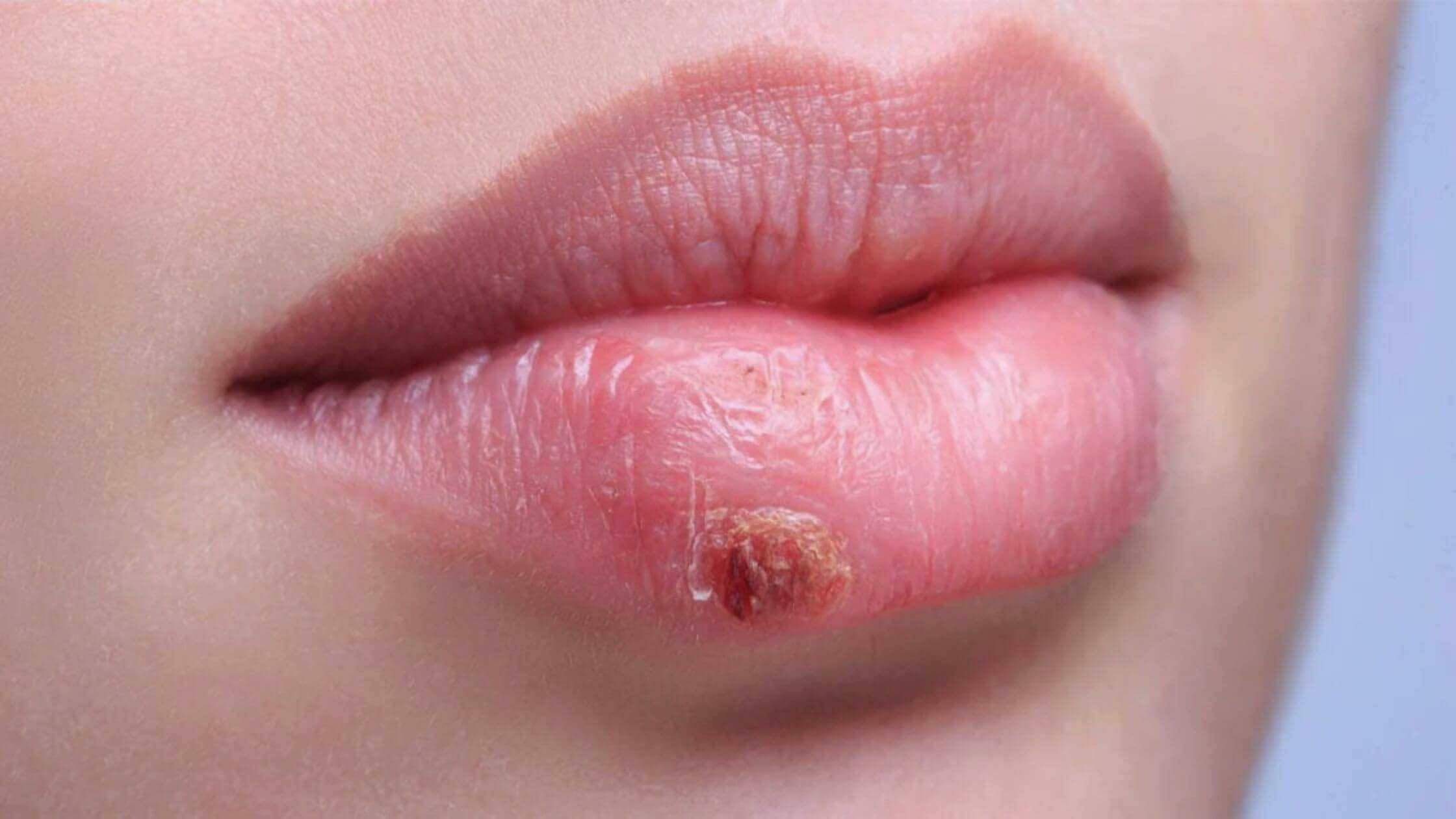 What Is Herpes? Types And Treatment