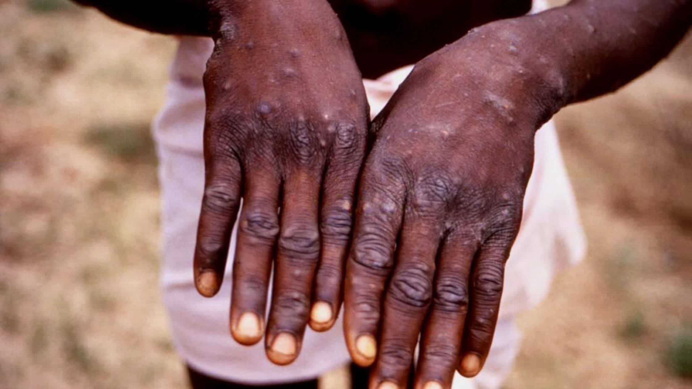 An Overview Of Monkeypox Outbreaks In African Union Countries