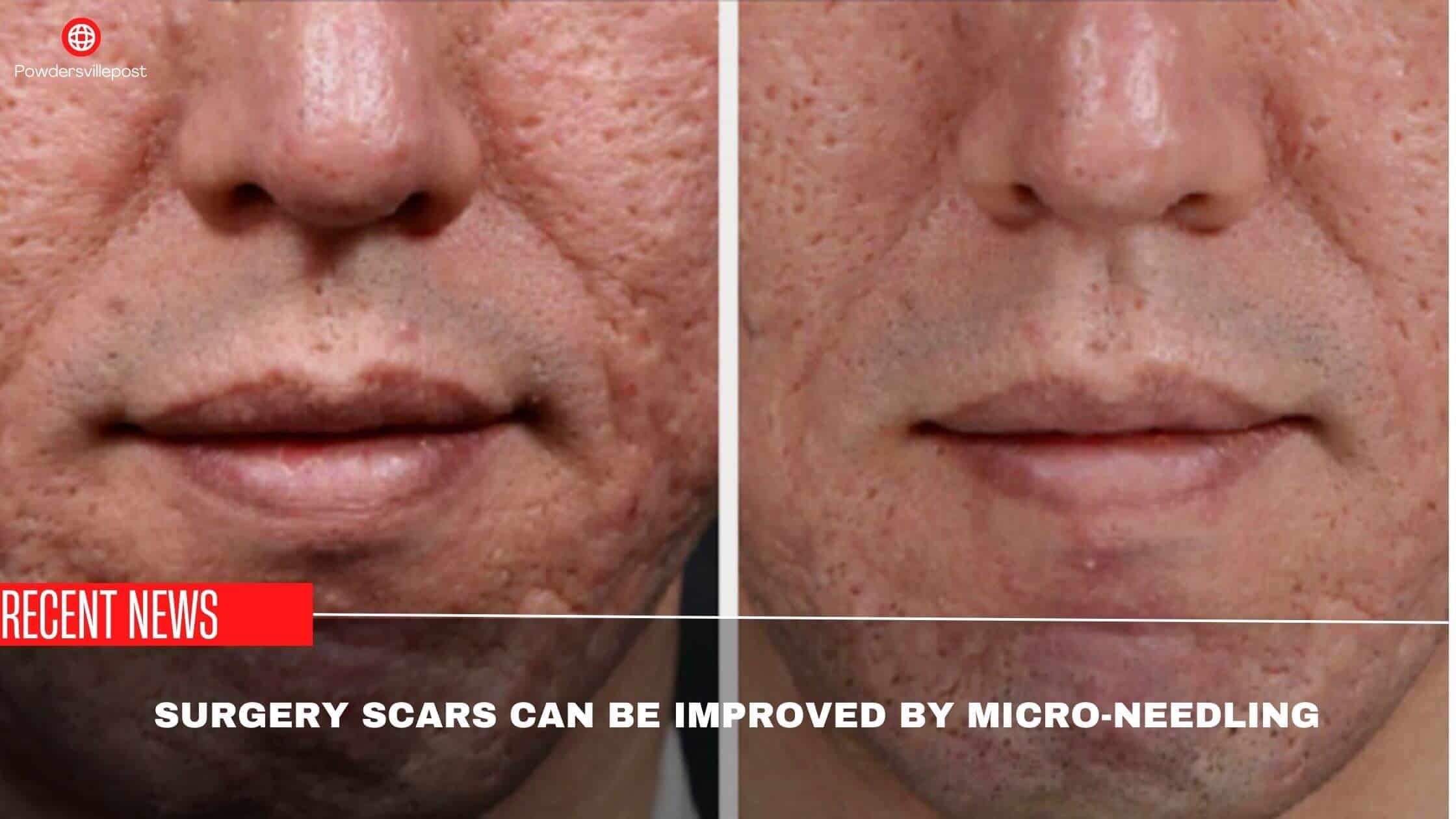 Surgery Scars Can Be Improved By Micro-Needling-Researchers Finding