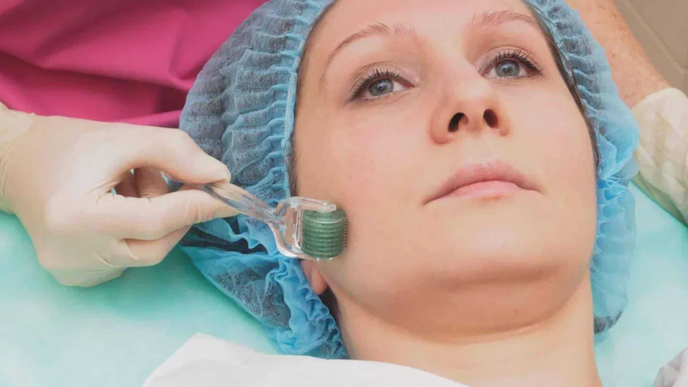 Surgery Scars Can Be Improved By Micro-Needling