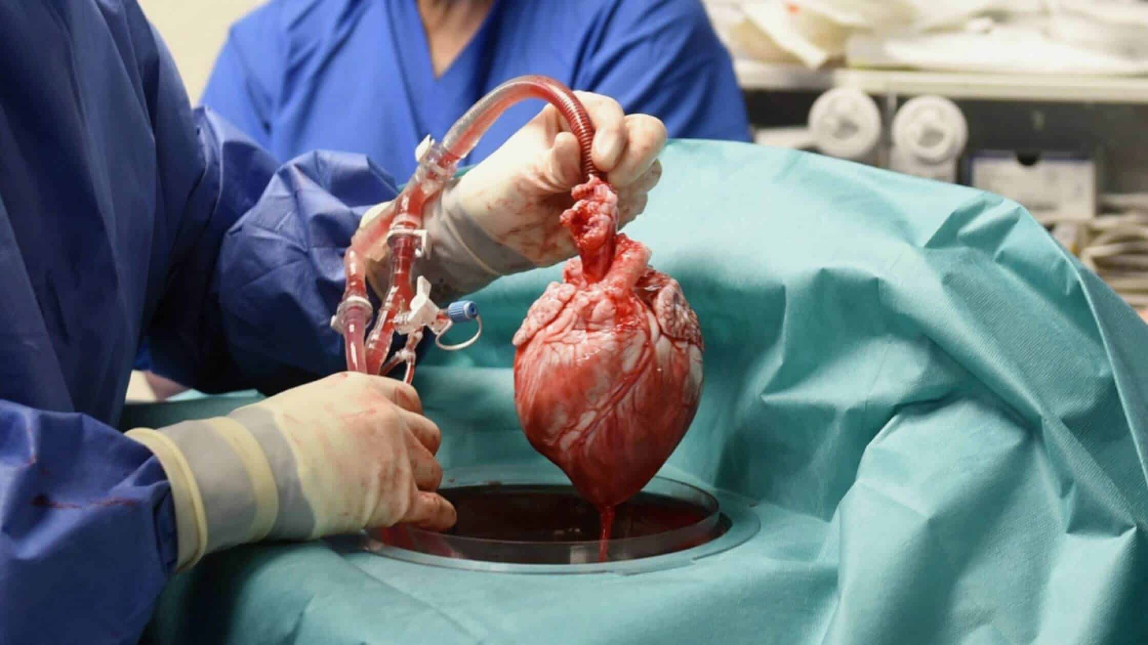 One Million Transplants And Counting The U.S's Search For More Organs